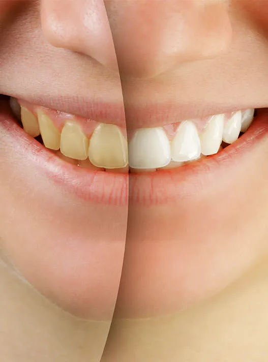 Professional teeth whitening